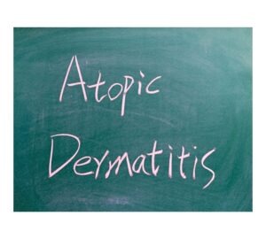 atopic dermatitis1